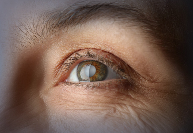 Glaucoma