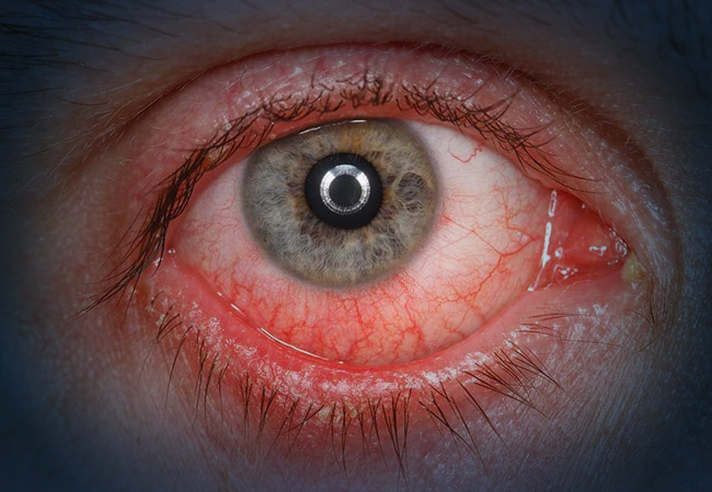 Retinal Tears & Detachment