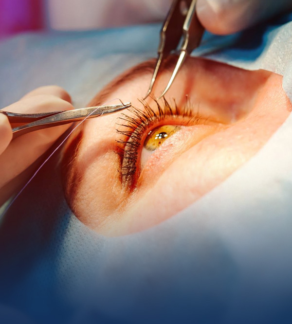 Vitrectomy for Diabetes